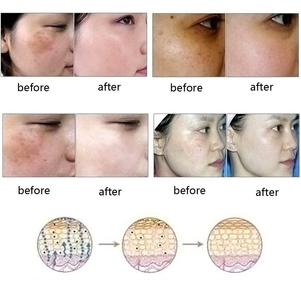 Dredge Meridian Skin Care Acne Removal